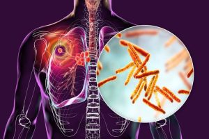 TB fight demands bold science partnerships